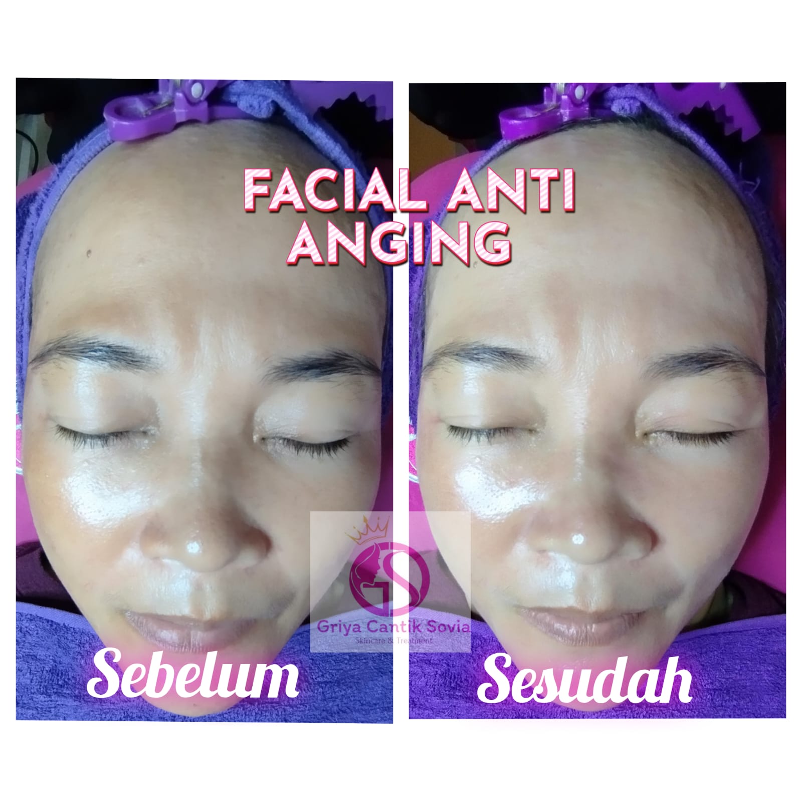 Testimoni Treatment 1 - DRW Skincare